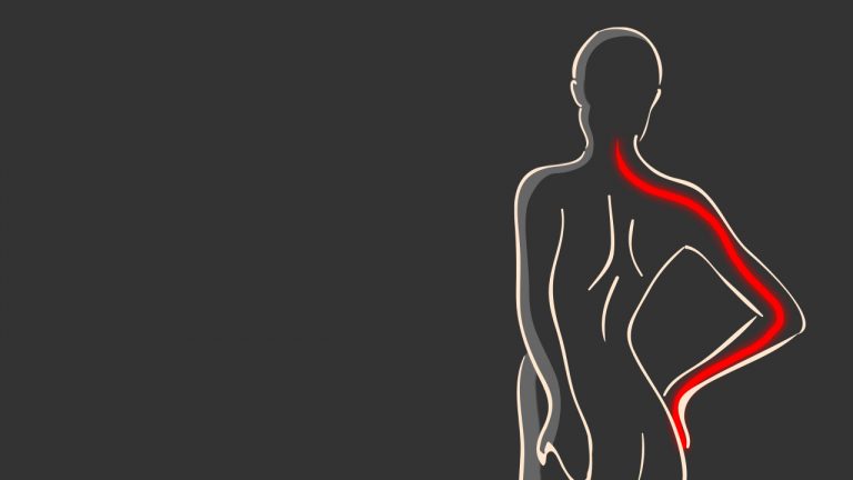 Névralgie Cervico brachiale