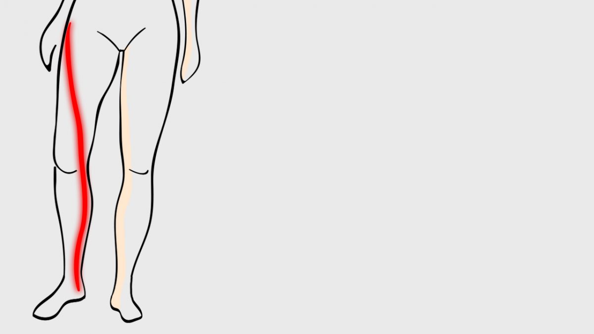 Comment dormir avec névralgie cervico brachiale?